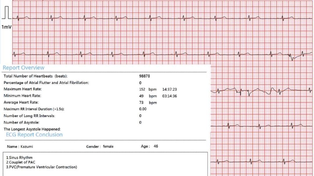 Wellue 12-Lead Holter Monitor with AI Analysis - 24-Hour Holter Monitoring  with AI report